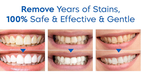 Teeth Whitening Essence